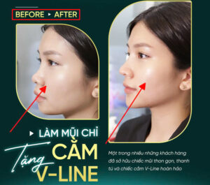 Hình ảnh có before after
